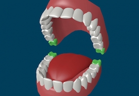 Зуби мудрості: лікувати або видаляти?