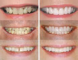 Реставрація зубів: фото до та після установки вінірів