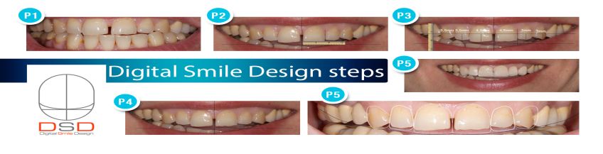 Цифровий дизайн посмішки (Естетична стоматологія, Digital Smile Design)