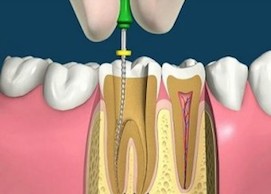 Болить зуб після видалення нерва, що робити?