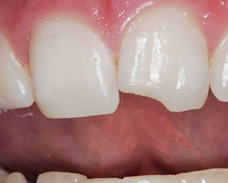 Класифікація травм зуба і методи їх лікування