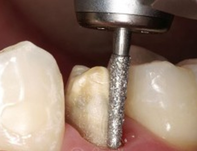  Препарування зубів - протезуванні в стоматології