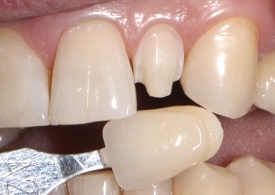 Реставрація зубів вінірами